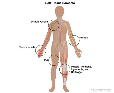 New Treatment Approved for Soft Tissue Sarcoma - NCI