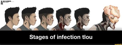 Stages of infection tlou - Stages of infection tlou - )