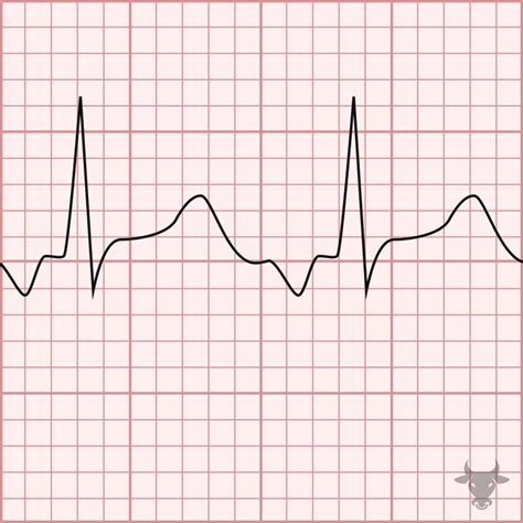 Atrial Tachycardia | ECG Stampede