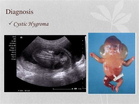 Cystic hygroma dt-2