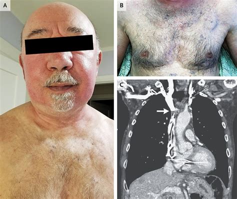 Pacemaker-Associated Superior Vena Cava Syndrome | NEJM