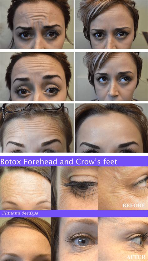 Botox Before And After Forehead