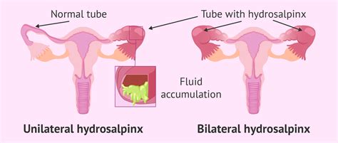 Hydrosalpinx in one or both tubes