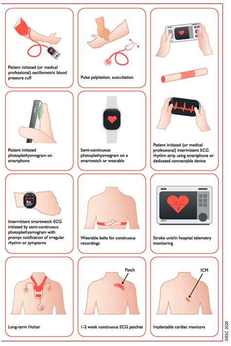 JCDD | Free Full-Text | ECG Smart Monitoring versus Implantable Loop Recorders for Atrial ...