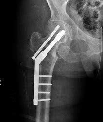 Internal Fixation - orthopedics