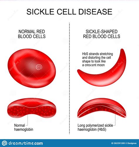 Sickle Cell Disease Cartoon Vector | CartoonDealer.com #262291285