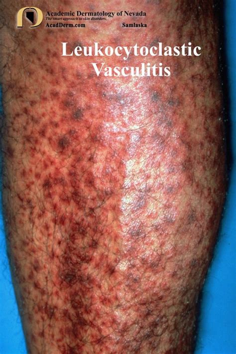 Leukocytoclastic Vasculitis: Small-Vessel Vasculitis... - Academic ...