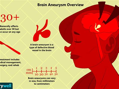 How To Detect A Brain Aneurysm - Sellsense23