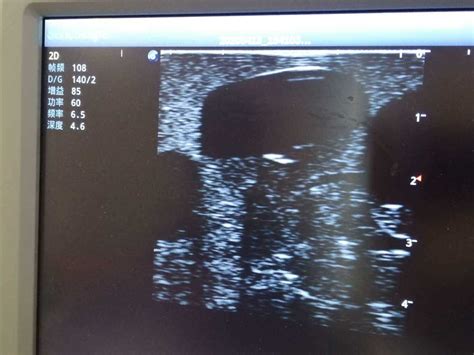 Abscess Drainage Ultrasound Trainer_Tellyes Scientific INC.