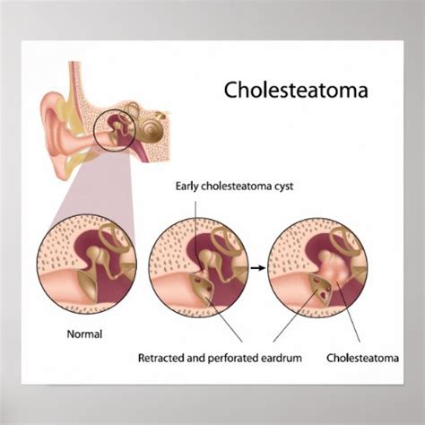 Cholesteatoma middle ear tumor Poster | Zazzle