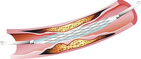 When do you need a heart stent? - Harvard Health