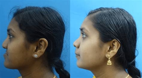 Retrognathic Maxilla | Retrognathic Jaw Surgery in India | Richardsons