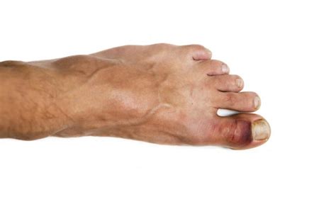 Broken toe: Treatments, symptoms, pictures, and healing time