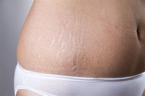 Stretch Marks – Glamderm