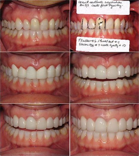 Chicago Porcelain Veneers | Benjamin S. Fiss, D.D.S.