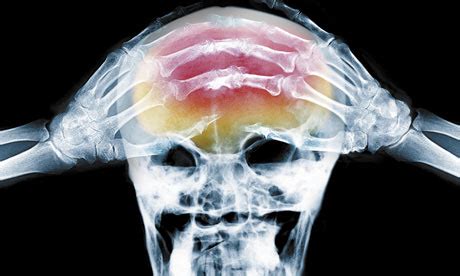 Reasonably Well: Sjogren's Syndrome and Headaches