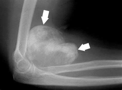 Imaging of Synovial Sarcoma with Radiologic-Pathologic Correlation ...