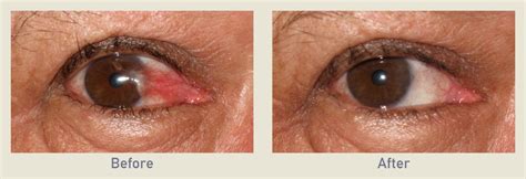 Pterygium Removal | Before & After Photo Gallery | Los Angeles