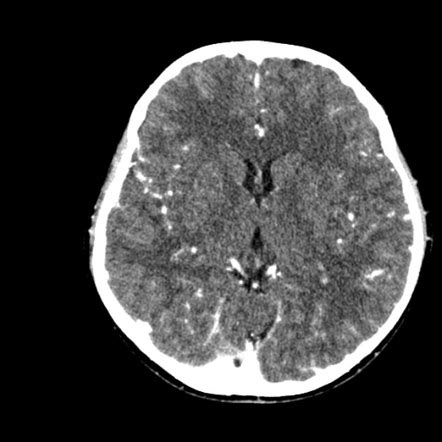 Normal CT brain with contrast: paediatric | Radiology Case ...