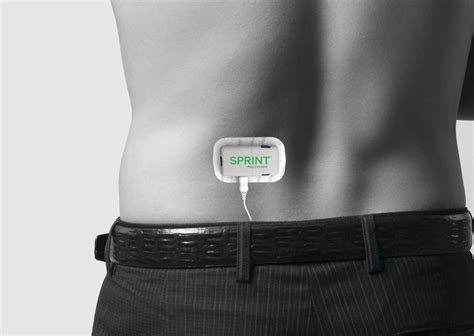 SPRINT® Peripheral Nerve Stimulation (PNS) | Twin Cities Pain Clinic