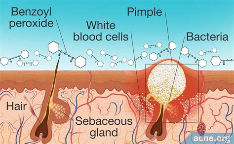 How Does Benzoyl Peroxide Work in the Skin? - Acne.org