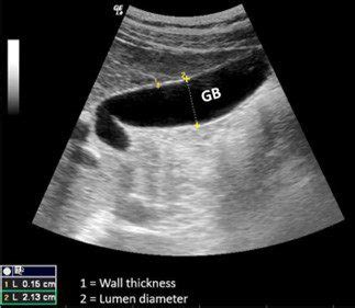 Acute Cholecystitis Ultrasound