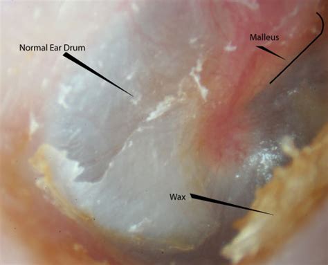 Ear Wax Images | McGovern Medical School