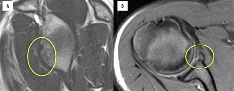 Sagittal and axial T2 images of the shoulder. The bony Bankart lesion... | Download Scientific ...