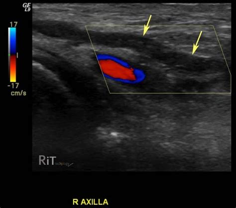 RiT radiology: Upper Extremity Deep Vein Thrombosis