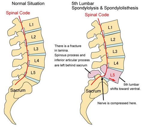 spondylolisthesis 2012 | Copyright © 2012 Kinou Kaifuku Chiropractic ...