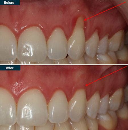 Receding Gums Treatment in NYC - New York Periodontist Dr. Rahmani