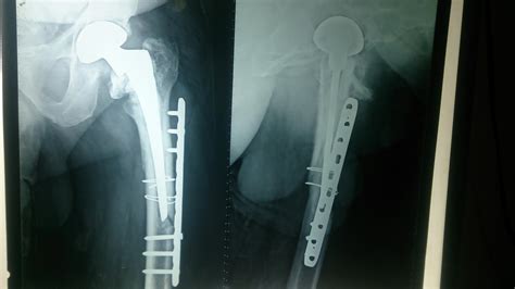 Periprosthetic Fracture Classification