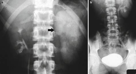 Uropathy, Pyonephrosis, and Reflux Nephropathy in Adults | Radiology Key