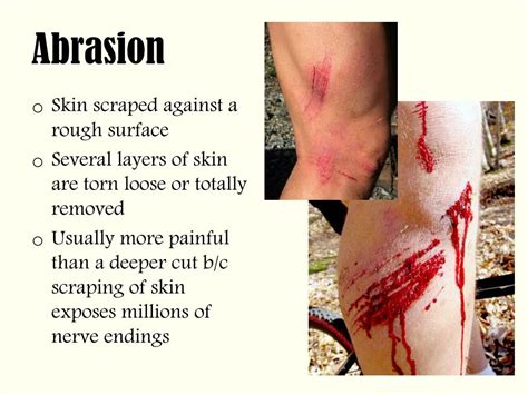 Abrasion Wound Diagram