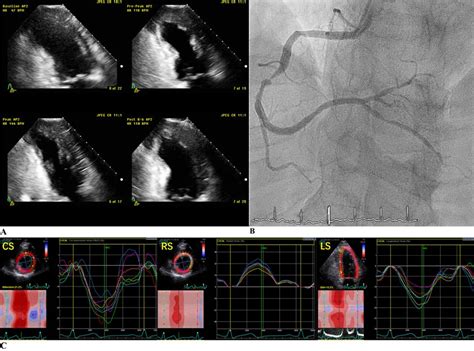 (a) Dobutamine stress echocardiography demonstrating stress-induced ...