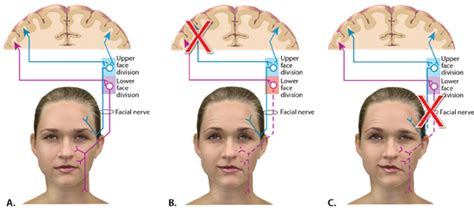 Exosomes 38: Bell’s (Facial Nerve) Palsy – Recharge Biomedical