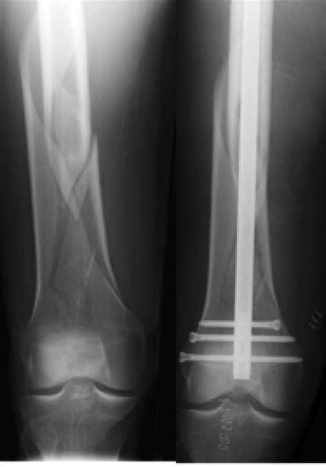 Femoral Shaft Fractures - Trauma - Orthobullets