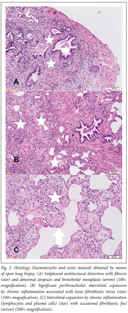 Interstitial Pneumonia Histology