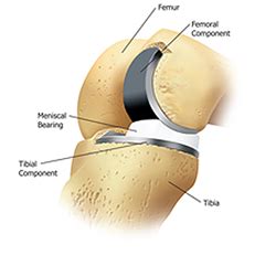 Oxford Partial Knee Replacement in Houston | Dr. Likover