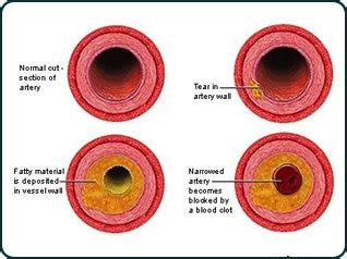 Coronary Artery Disease - Florida Cardiology, P.A.