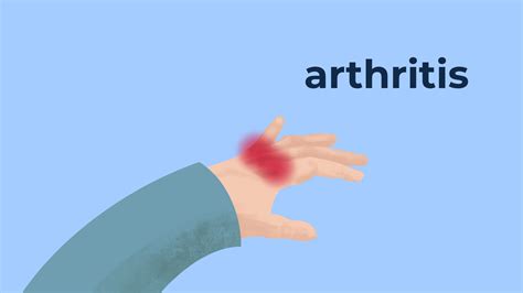 How To Manage Your Chronic Pain and Arthritis