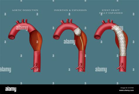 Illustration depicting insertion of an aortic aneurysm stent. Far Stock Photo, Royalty Free ...