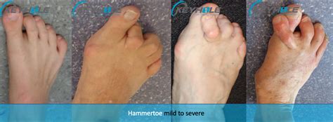 Hammer Toe Before And After