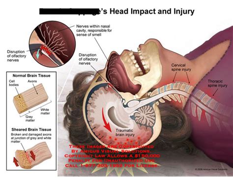 AMICUS Illustration of amicus,injury,head,impact,floor,brain,nerve,olfactory,smell,tissue,axonal ...