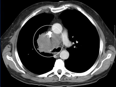 Superior Vena Cava Syndrome (SVCS) – Localization & Treatment Procedures in Radiation Therapy