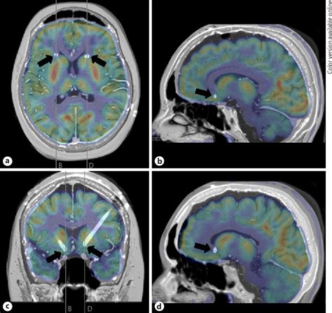 Deep Brain Stimulation of Subgenual Cingulate Region for Treatment of ...