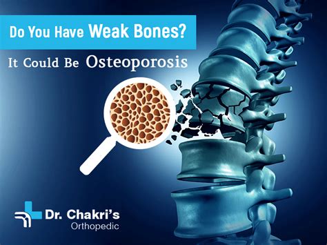 Do You Have Weak Bones? It Could Be Osteoporosis. - Dr. Chakradhar