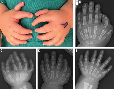 Surgical Reconstruction for the Triphalangeal Thumb : Plastic and Reconstructive Surgery ...