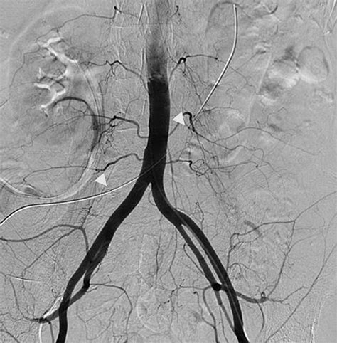 Ureterostomy Stent