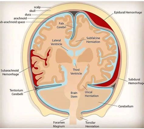 Intracranial Hemorrhage - MEDizzy